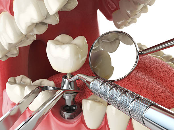 Best Broken or Chipped Tooth Repair in Pocomoke City, MD